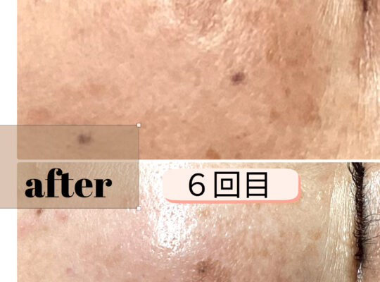 シミポイント＋プラズマケア