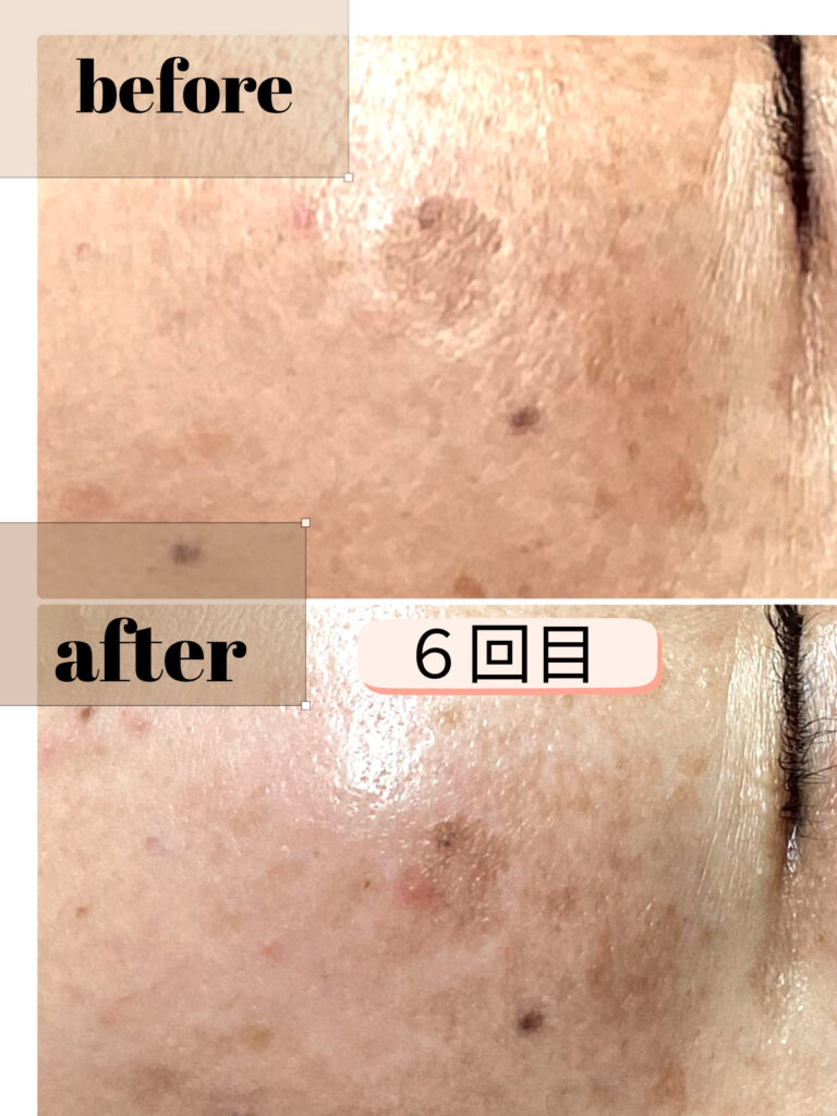 シミポイント＋プラズマケア