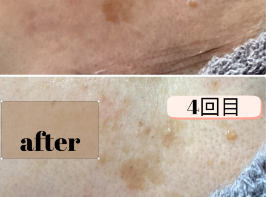 シミポイント＋プラズマケア