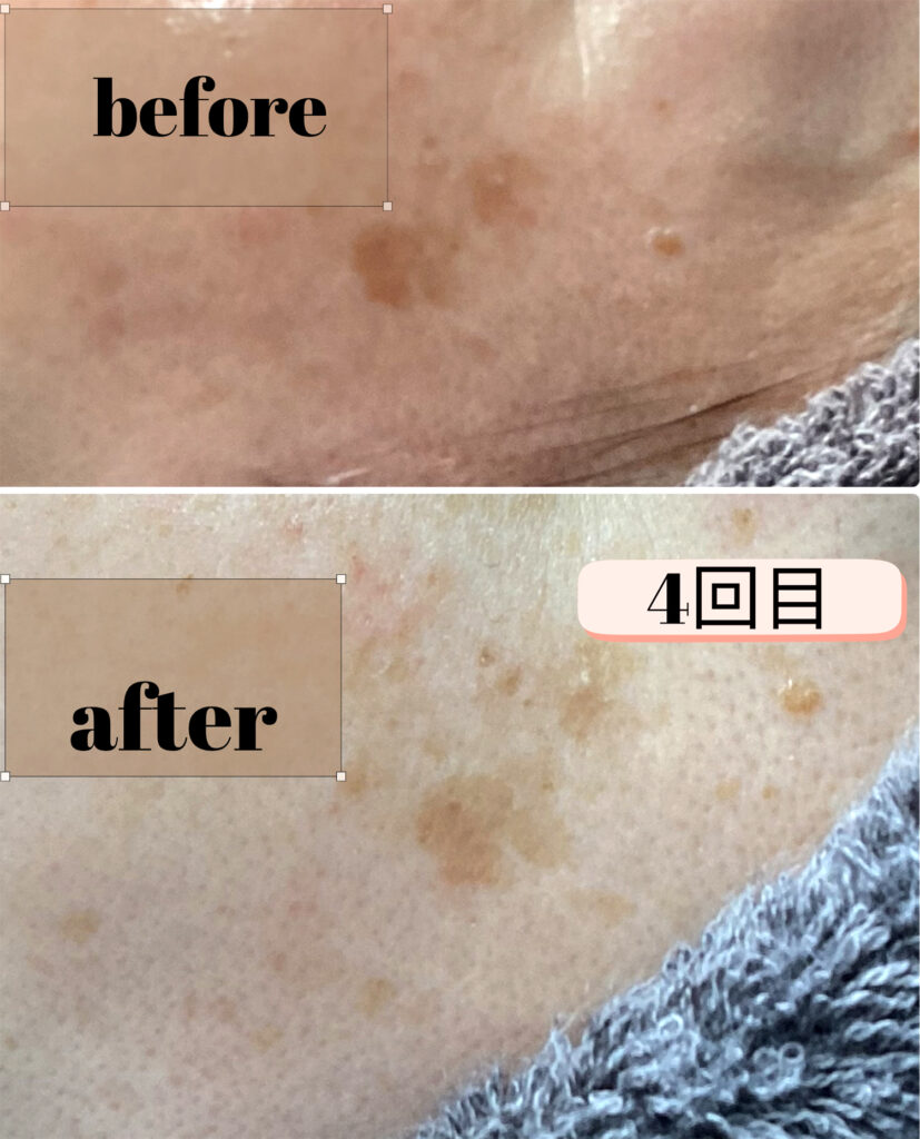 シミポイント＋プラズマケア