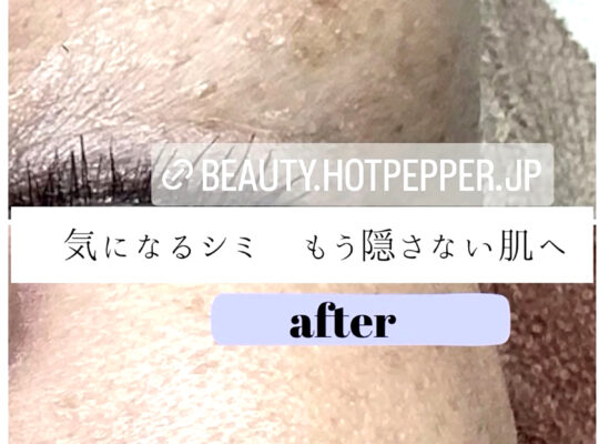 シミポイント＋プラズマケア