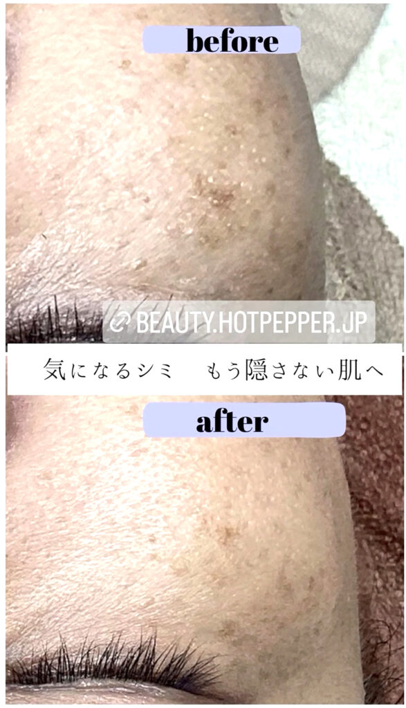 シミポイント＋プラズマケア