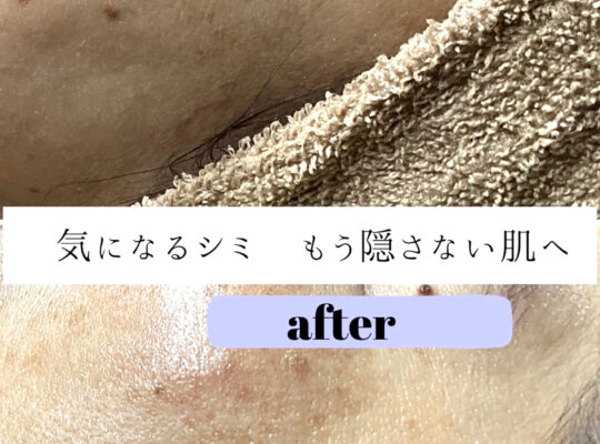 シミポイント＋プラズマケア