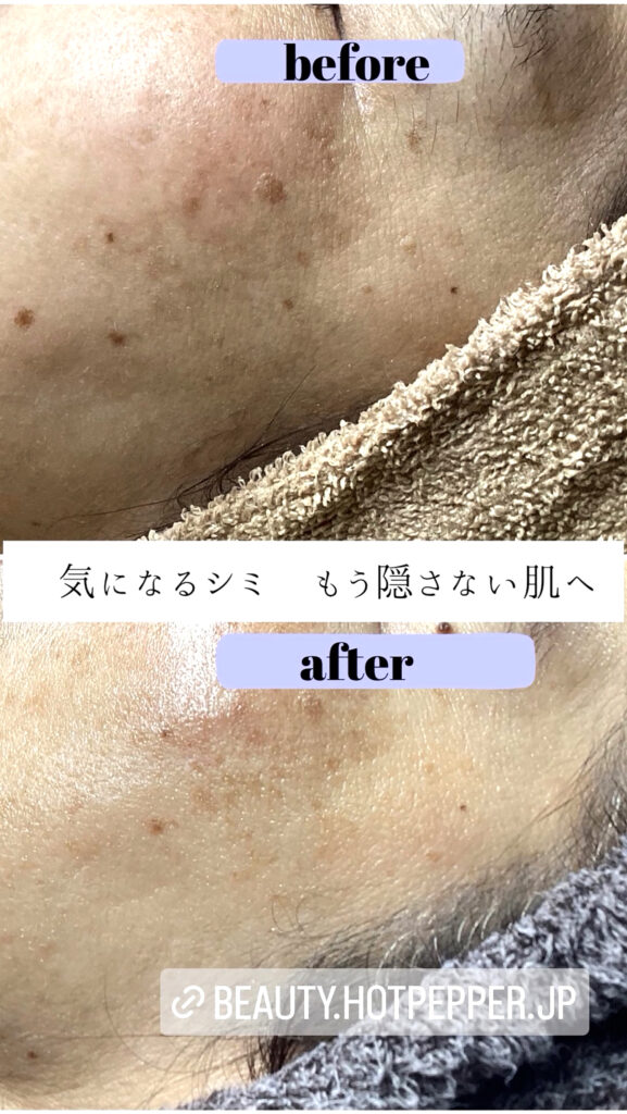 シミポイント＋プラズマケア