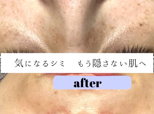 シミポイント＋プラズマケア