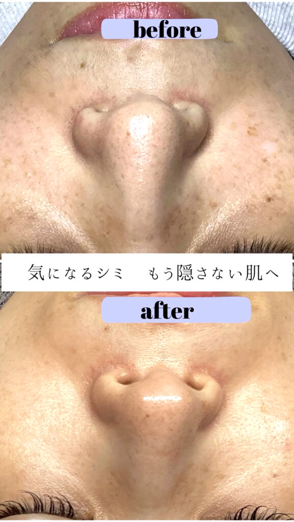 シミポイント＋プラズマケア