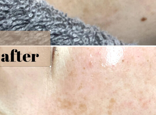 シミポイント＋プラズマケア