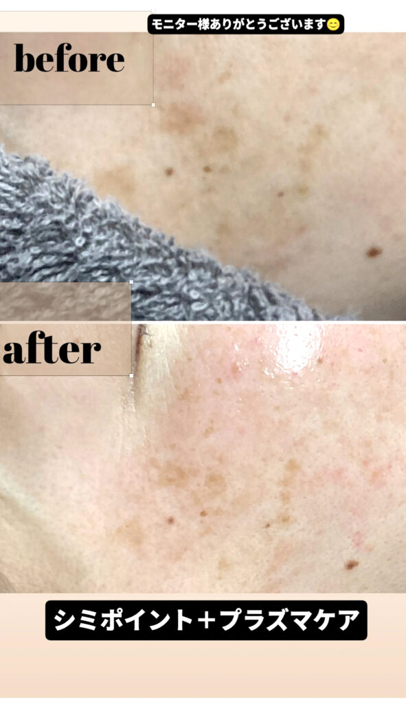 シミポイント＋プラズマケア